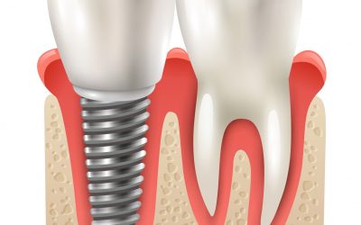 Cirugía Dental Avanzada en DEBA HORTZ KLINIKA: Tecnología de Vanguardia para una Sonrisa Saludable