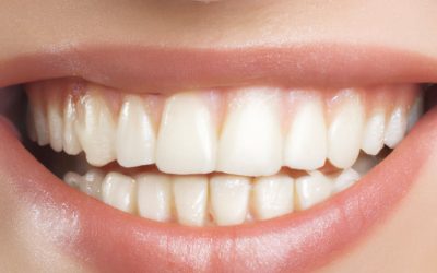 Preguntas Frecuentes sobre Blanqueamiento Dental: Mitos y Realidades